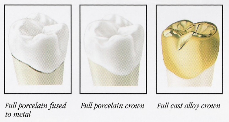 Affordable dental crowns in Hornsby.