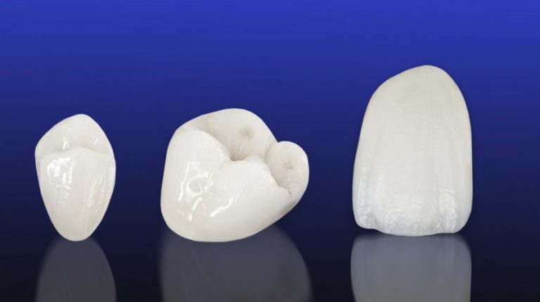 Porcelain Crown Cost | Hornsby Dental Clinic